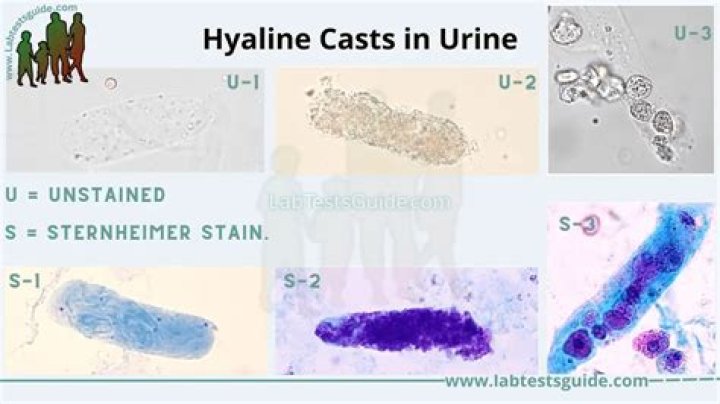 What are hyaline casts in a urinalysis?
